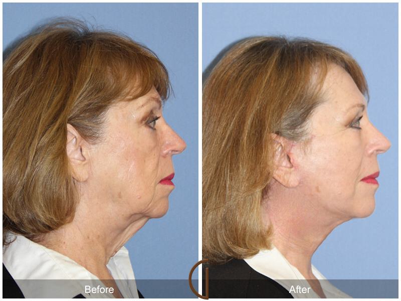 Facelift Sixties Before & After Photo