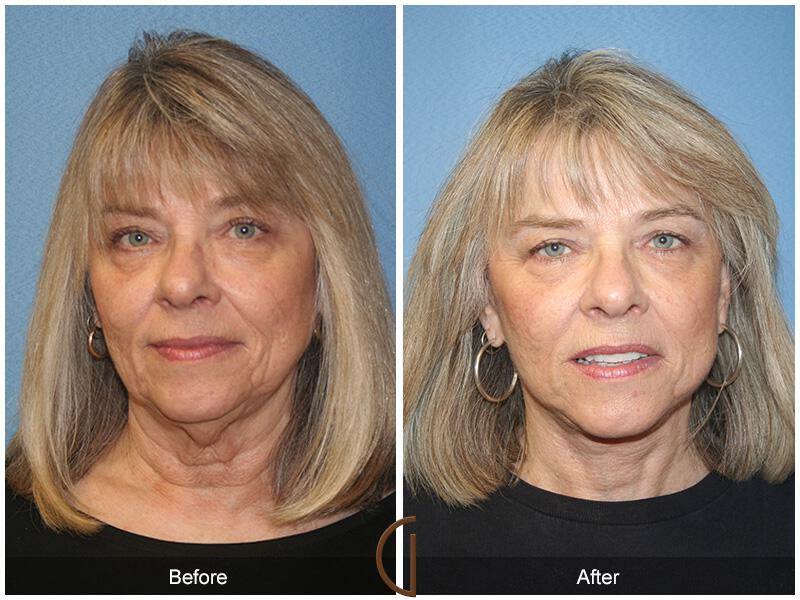 Facelift Sixties Before & After Photo