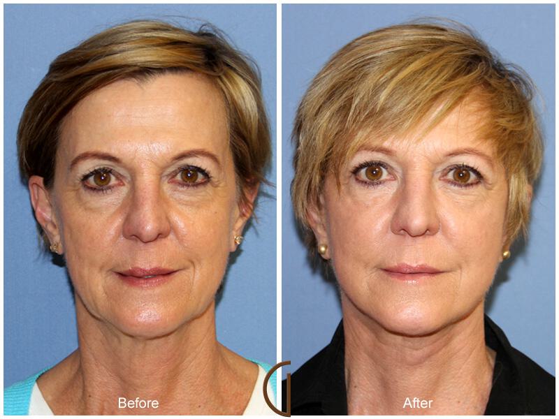 Facelift Sixties Before & After Photo