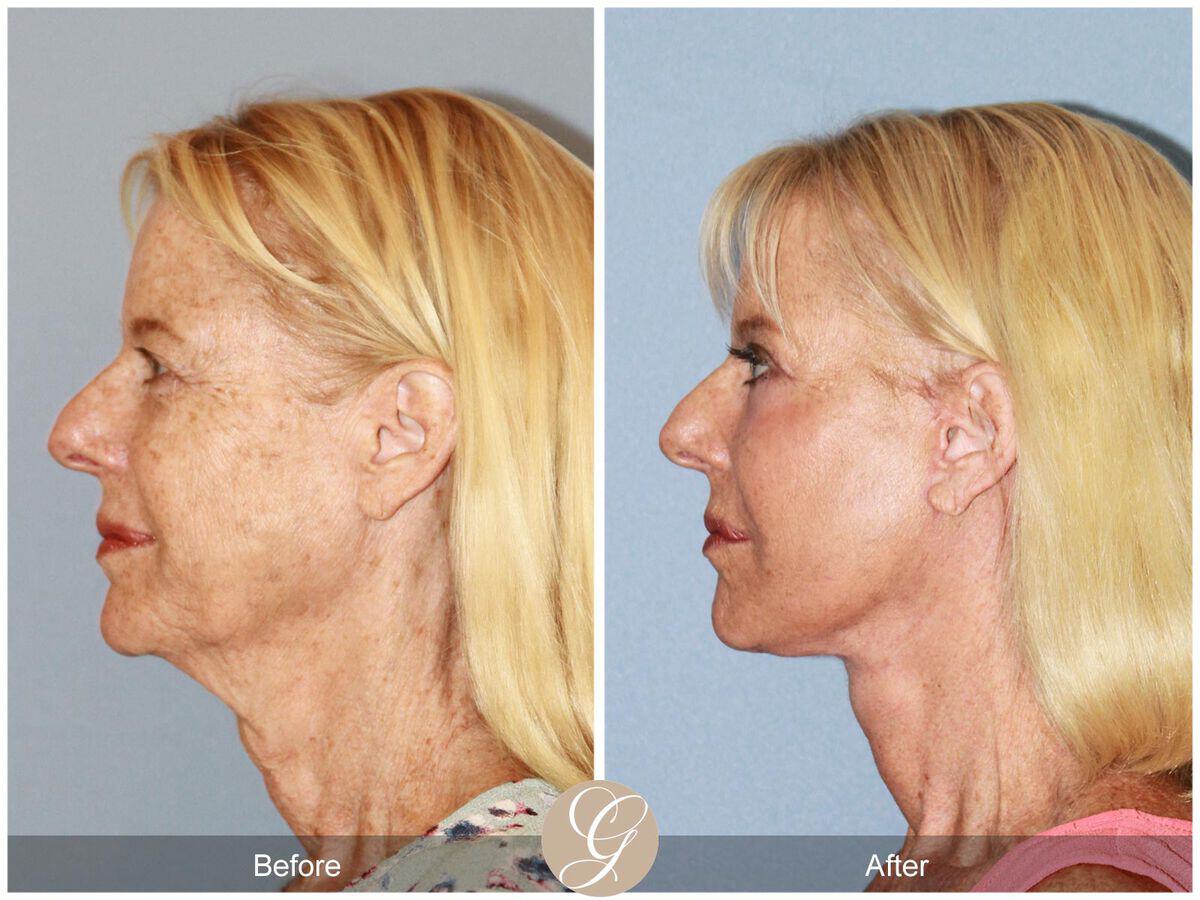 Facelift Sixties Before & After Photo