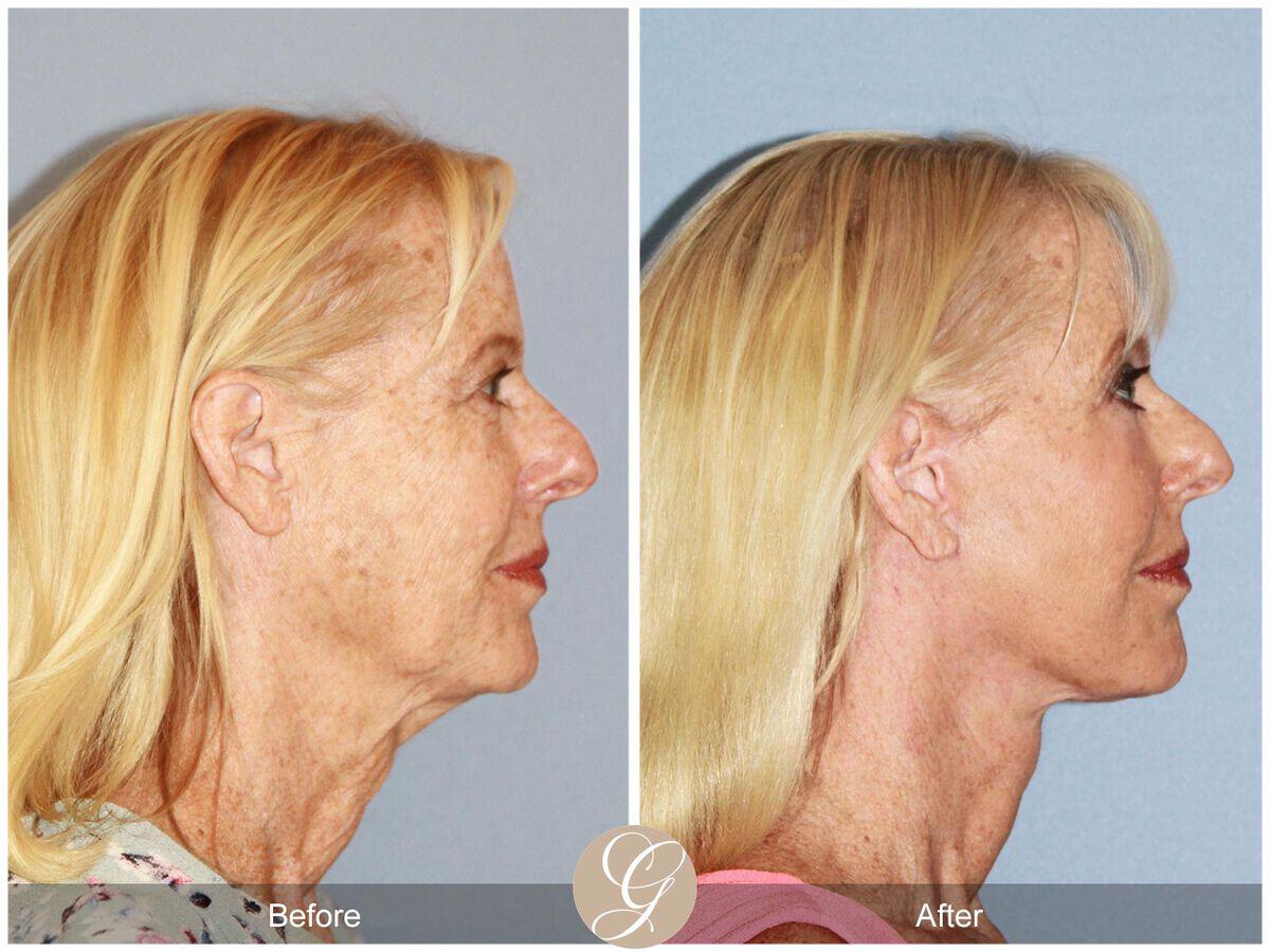 Facelift Sixties Before & After Photo