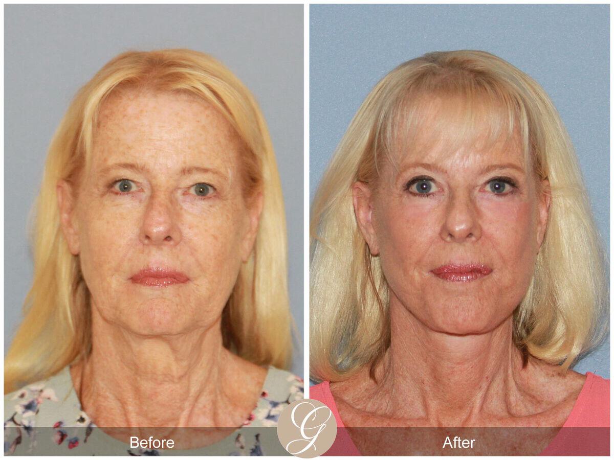 Facelift Sixties Before & After Photo