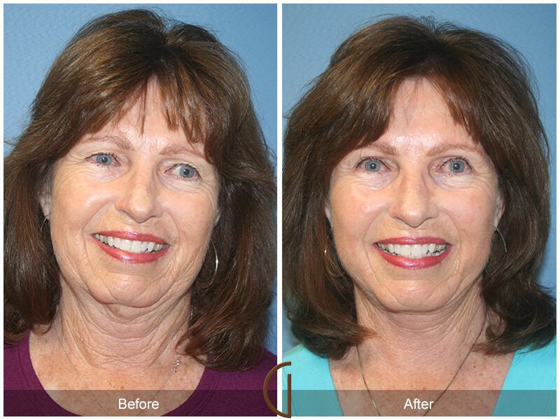 Facelift Sixties Before & After Photo