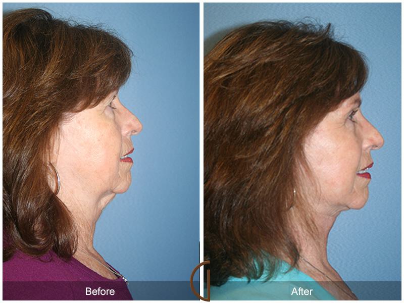 Facelift Sixties Before & After Photo