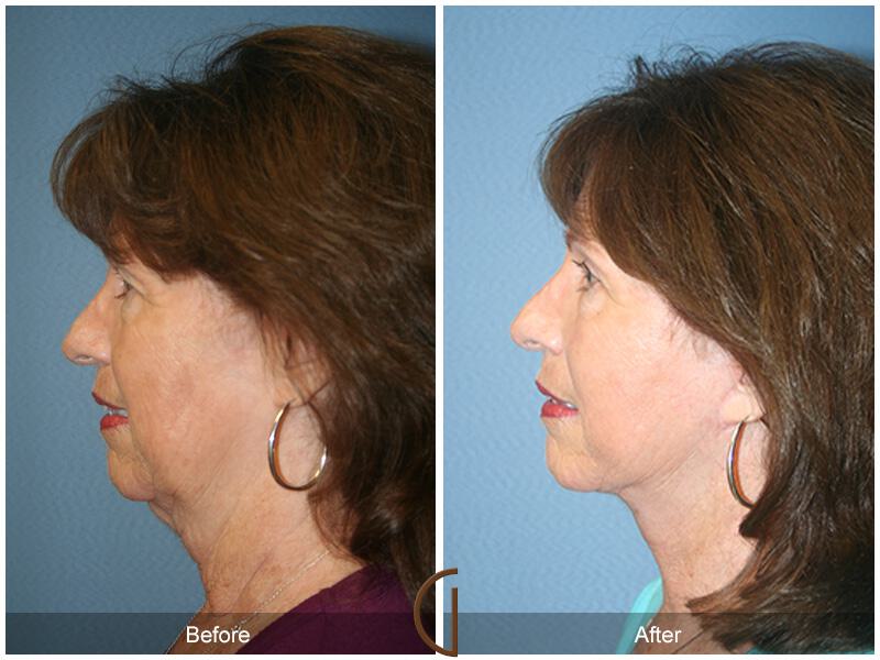 Facelift Sixties Before & After Photo