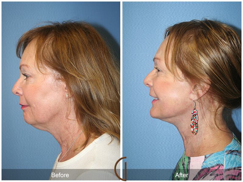 Facelift Sixties Before & After Photo