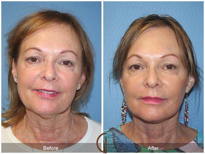 Facelift Sixties Before & After Photo