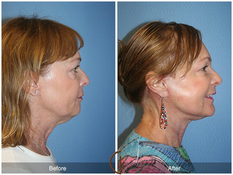 Facelift Sixties Before & After Photo