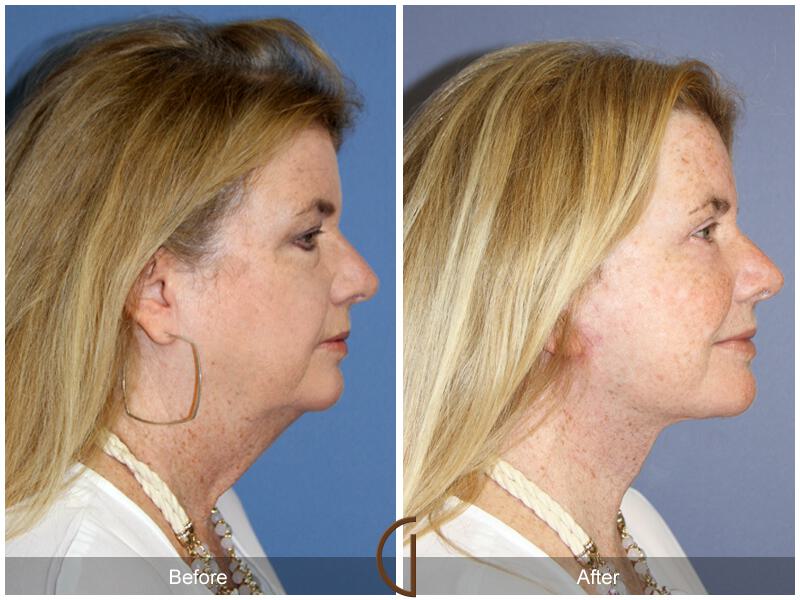 Facelift Sixties Before & After Photo