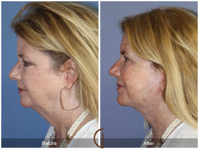 Facelift Sixties Before & After Photo