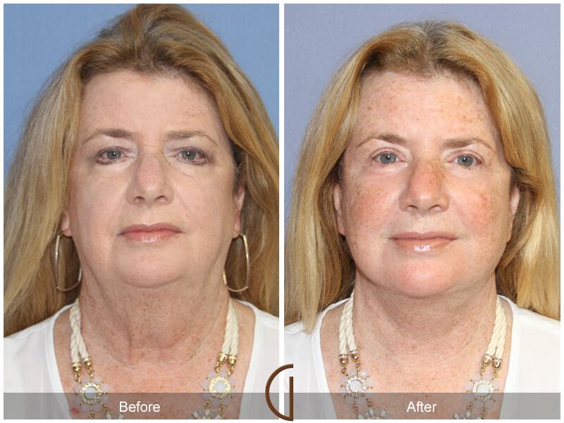 Facelift Sixties Before & After Photo