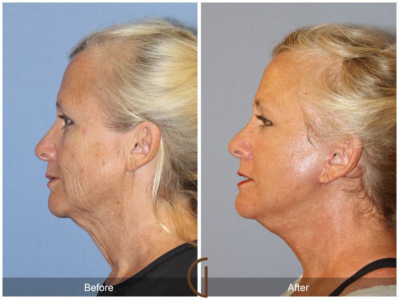 Facelift Sixties Before & After Photo