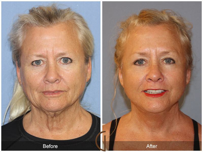 Facelift Sixties Before & After Photo