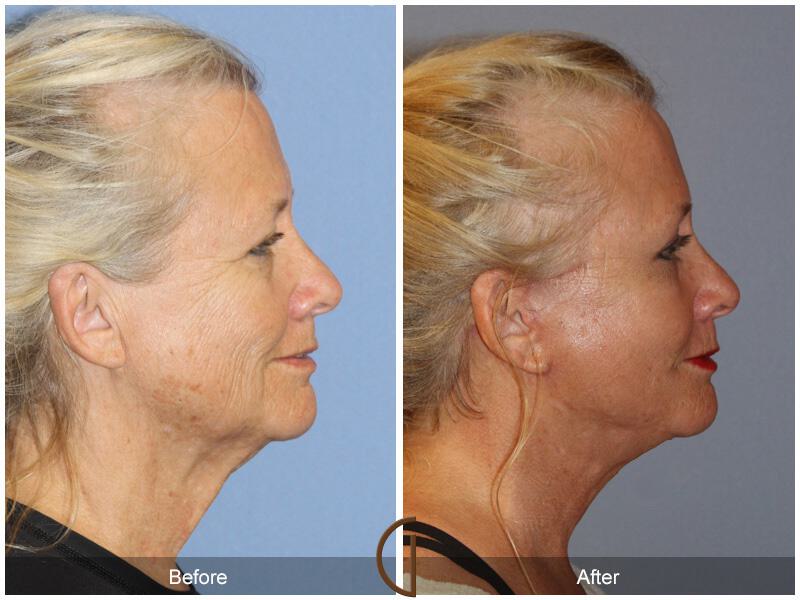 Facelift Sixties Before & After Photo