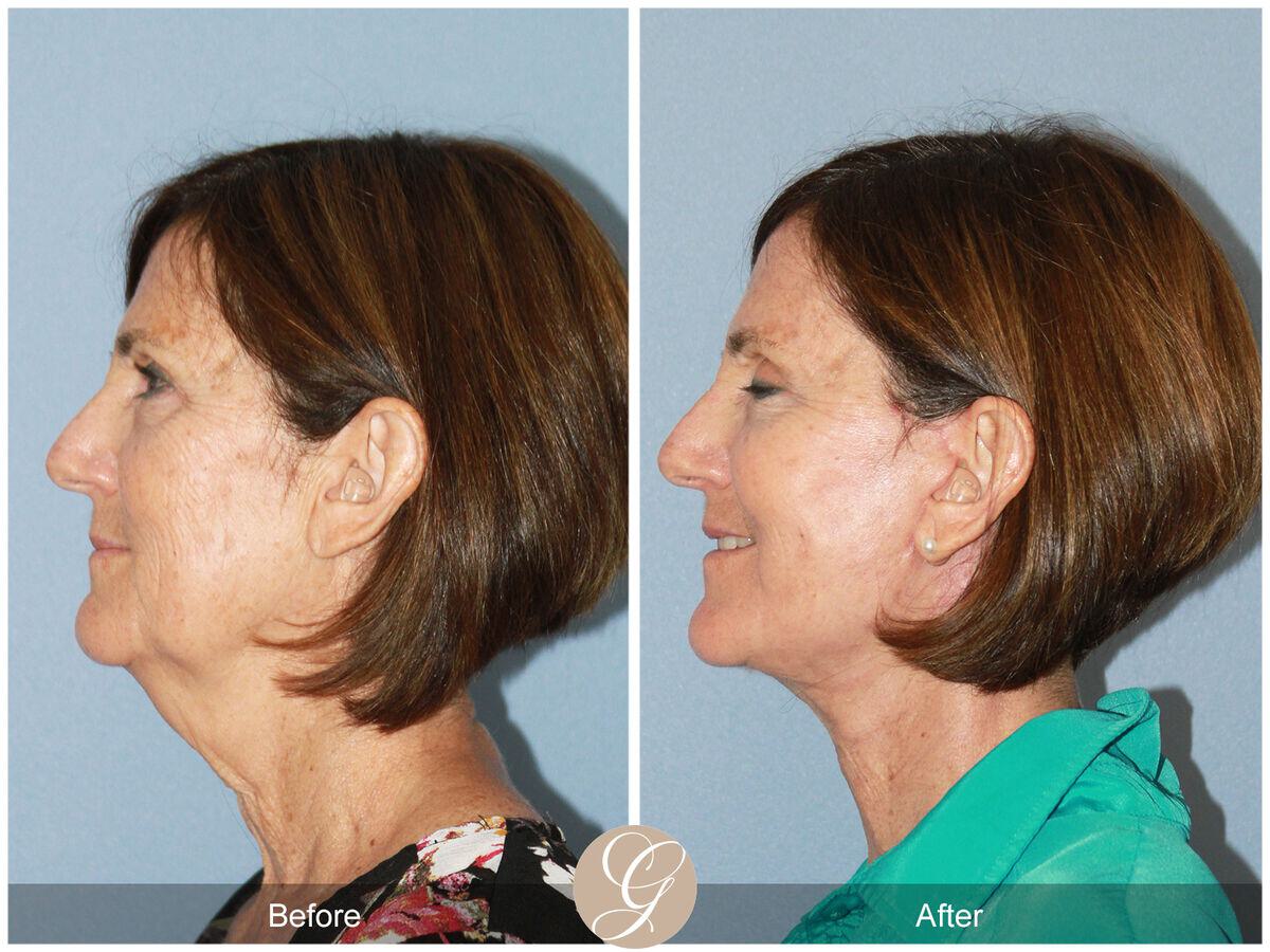 Facelift Sixties Before & After Photo