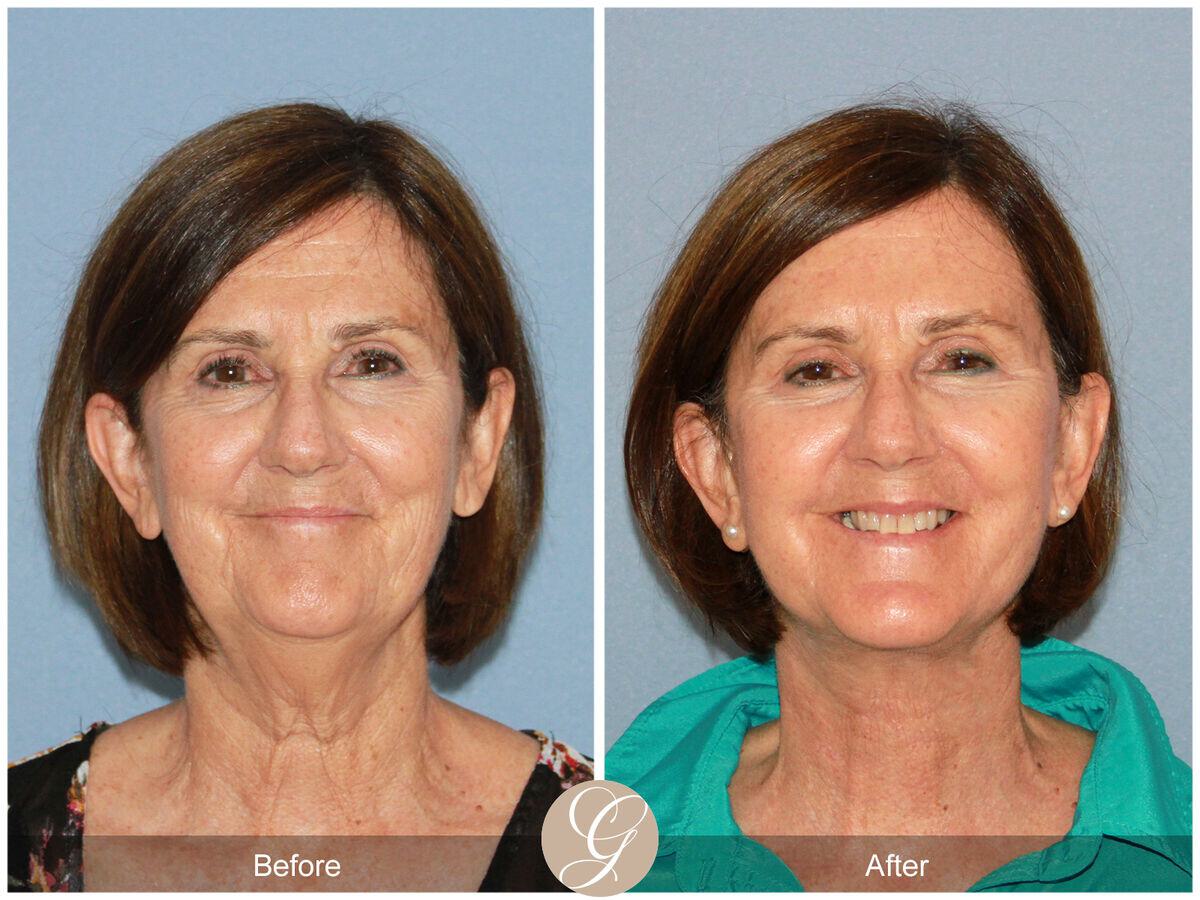 Facelift Sixties Before & After Photo