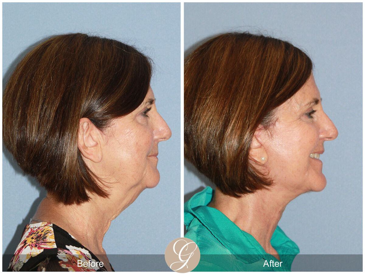 Facelift Sixties Before & After Photo