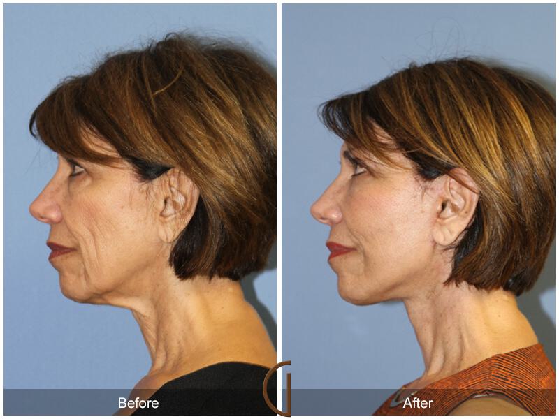 Facelift Sixties Before & After Photo