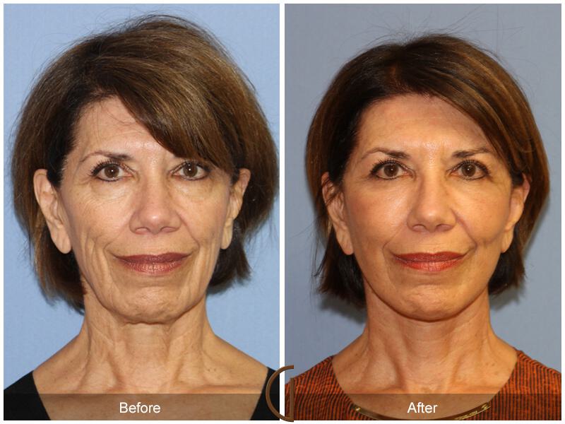 Facelift Sixties Before & After Photo