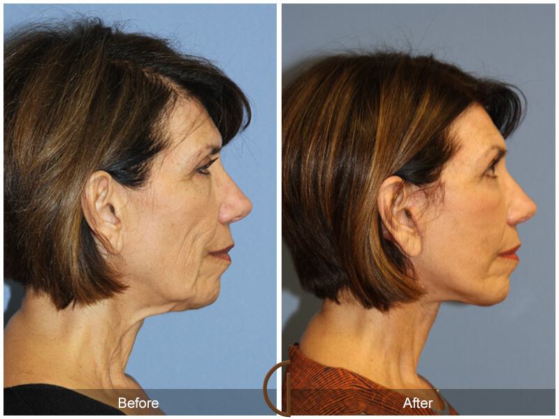 Facelift Sixties Before & After Photo