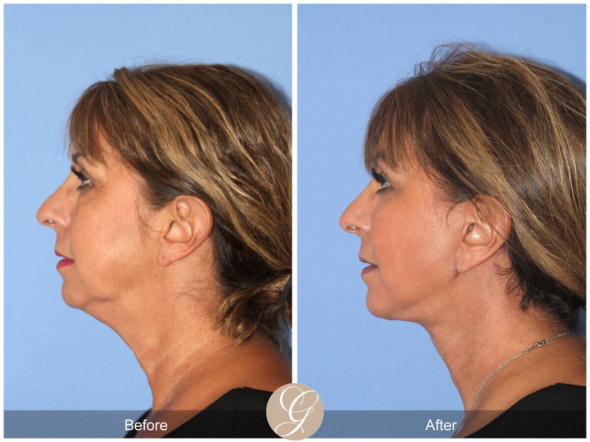 Facelift Sixties Before & After Photo