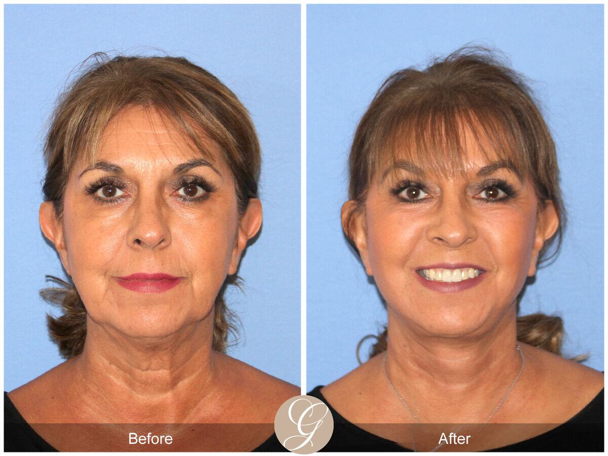 Facelift Sixties Before & After Photo