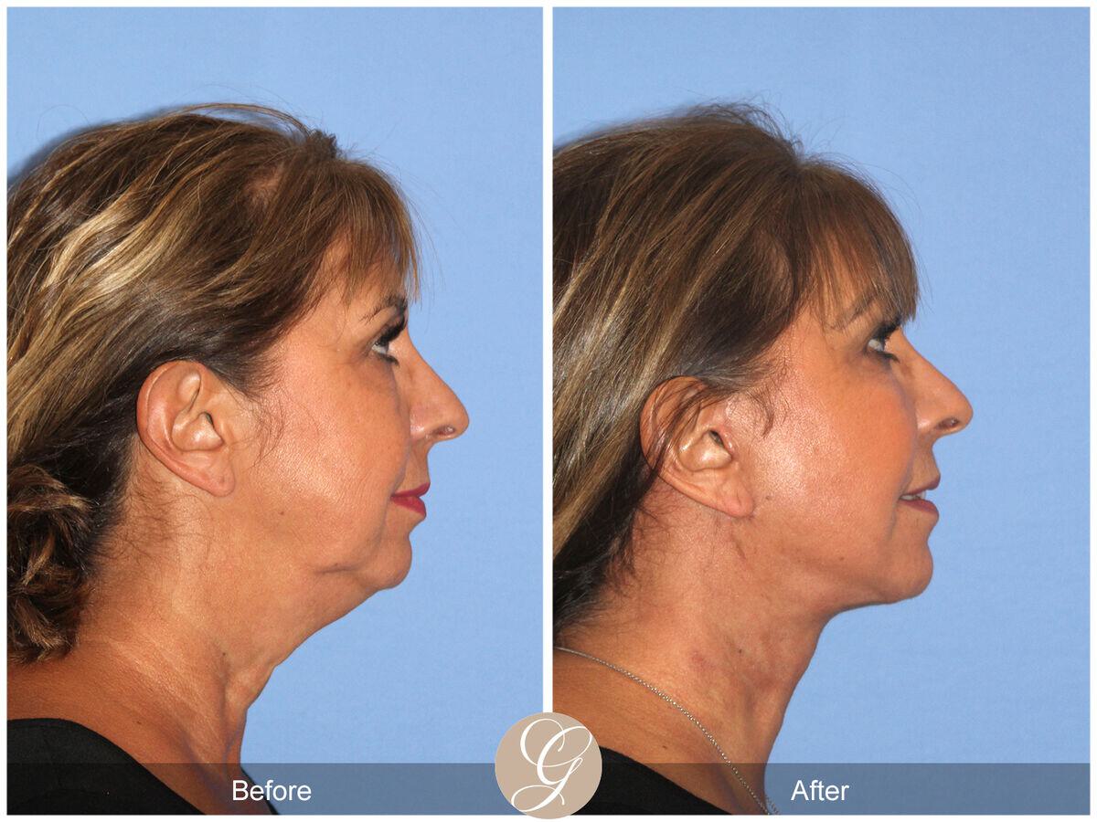 Facelift Sixties Before & After Photo