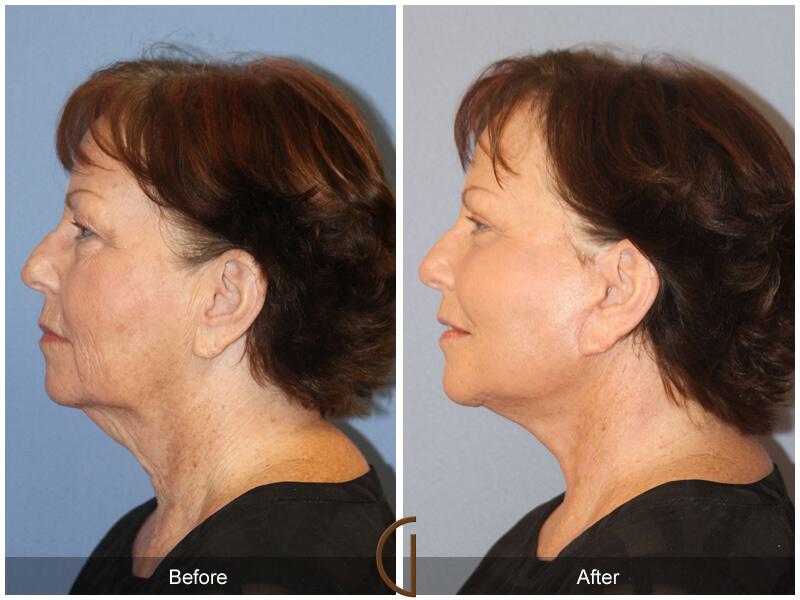 Facelift Sixties Before & After Photo