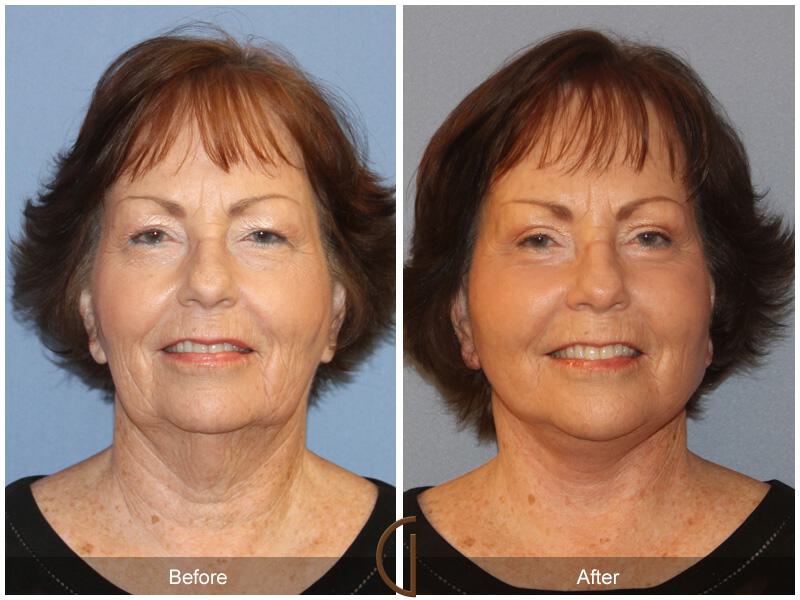 Facelift Sixties Before & After Photo