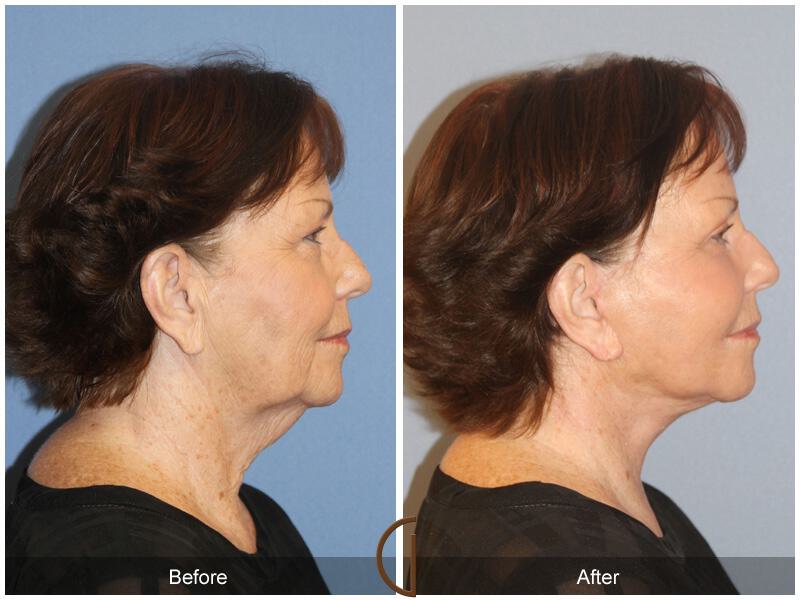 Facelift Sixties Before & After Photo