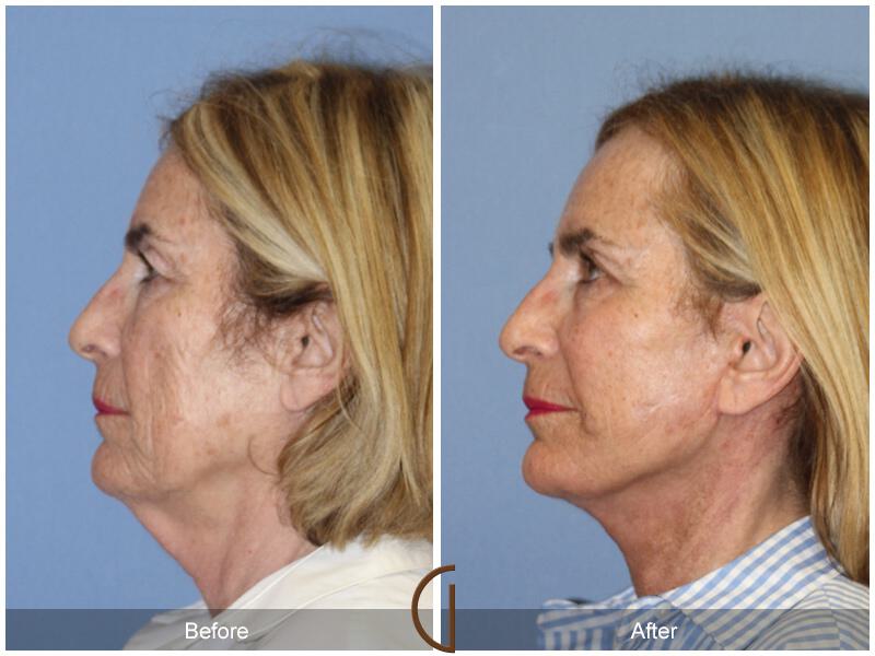 Facelift Sixties Before & After Photo