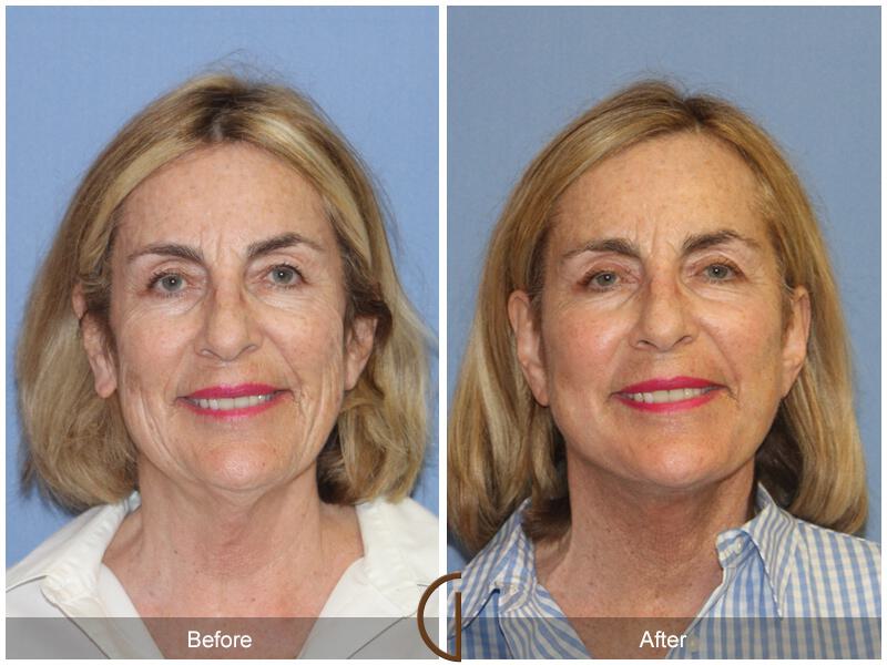 Facelift Sixties Before & After Photo