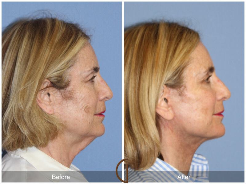 Facelift Sixties Before & After Photo