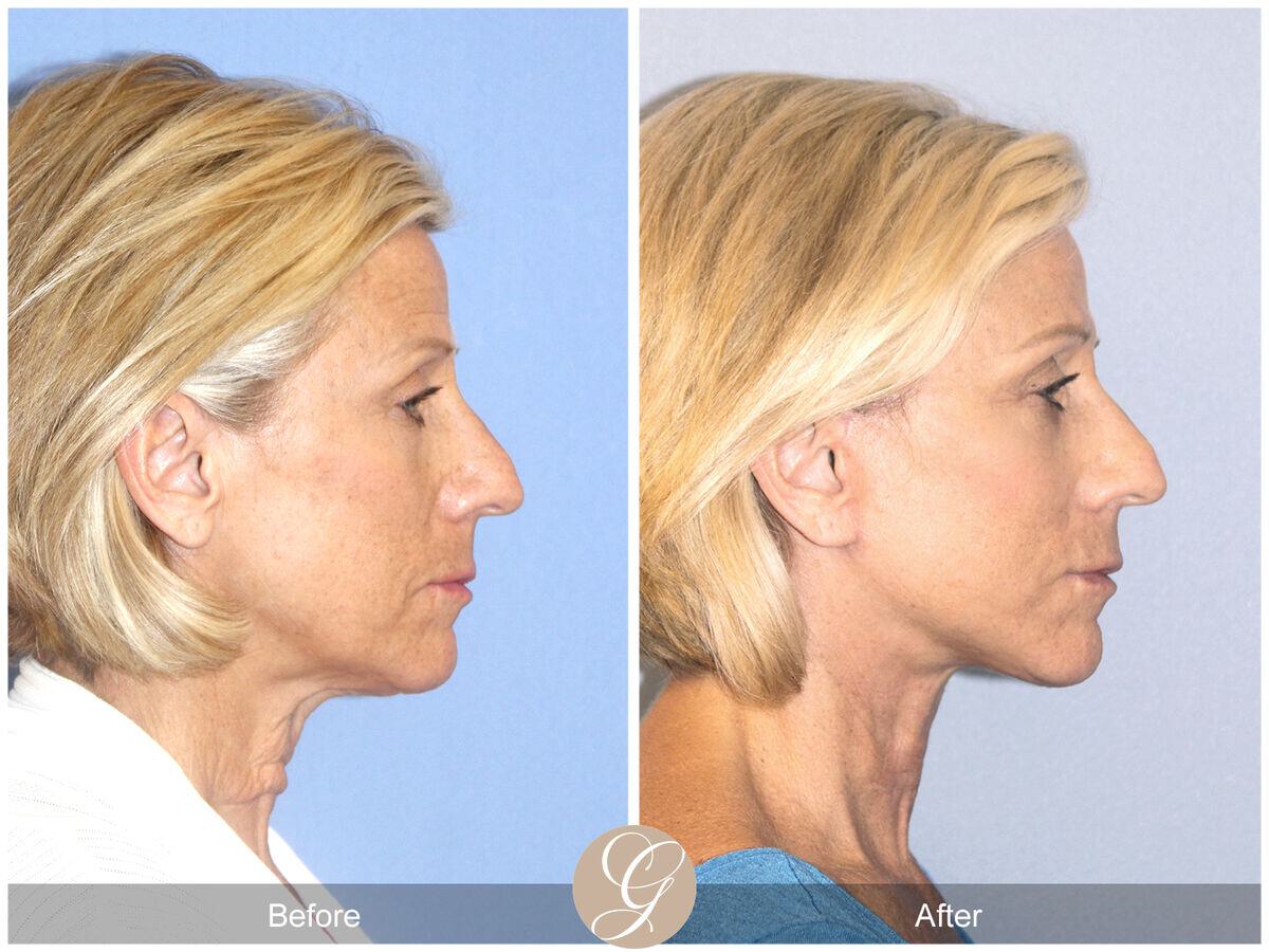 Facelift Sixties Before & After Photo