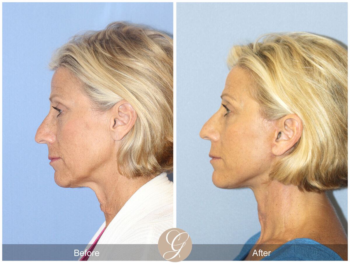 Facelift Sixties Before & After Photo