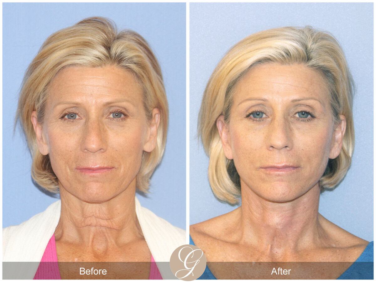 Facelift Sixties Before & After Photo