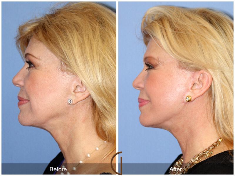 Facelift Sixties Before & After Photo