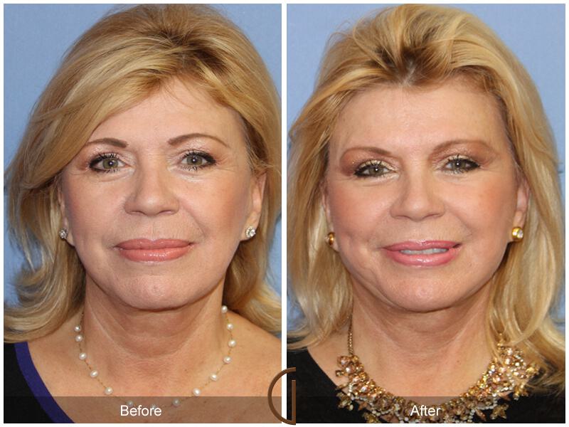 Facelift Sixties Before & After Photo