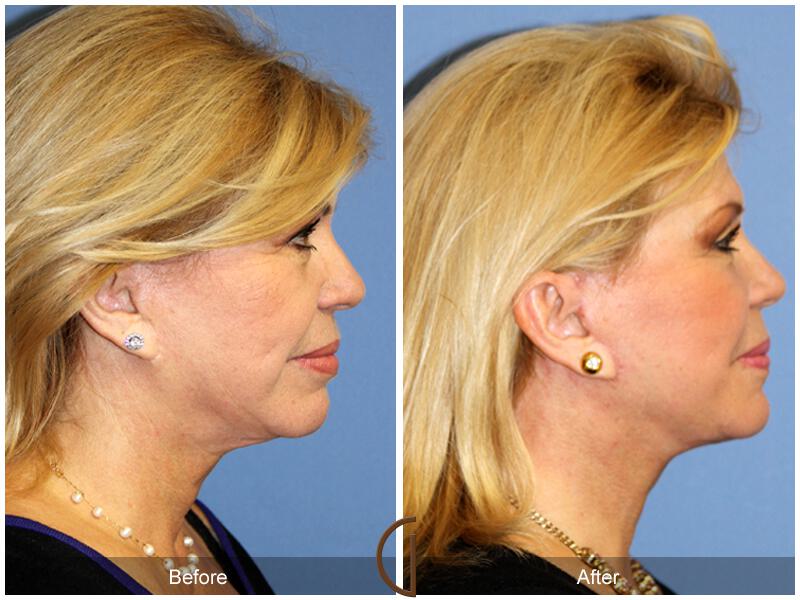 Facelift Sixties Before & After Photo