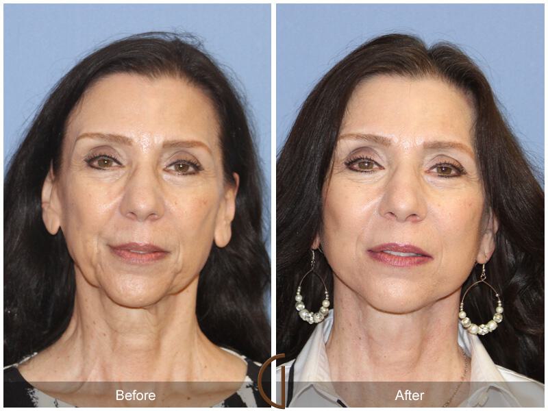 Facelift Sixties Before & After Photo