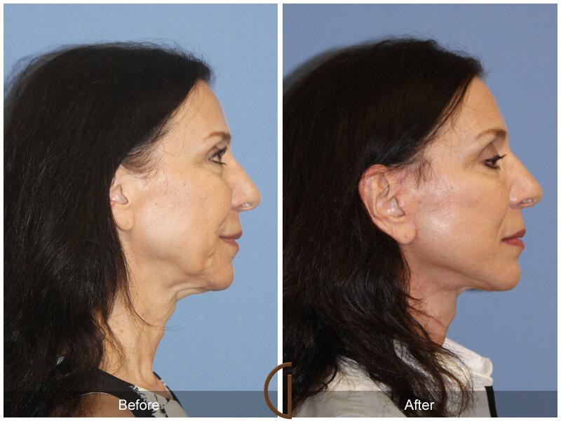 Facelift Sixties Before & After Photo