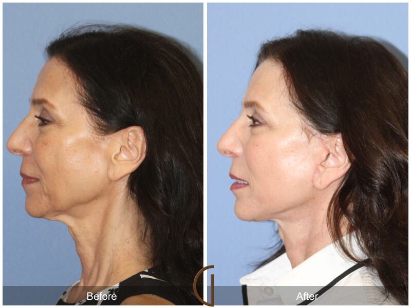 Facelift Sixties Before & After Photo