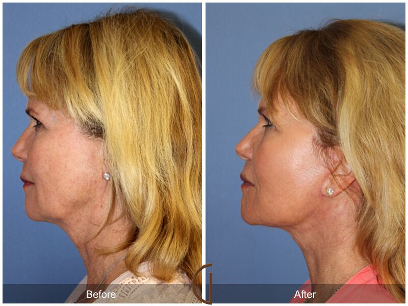 Facelift Sixties Before & After Photo