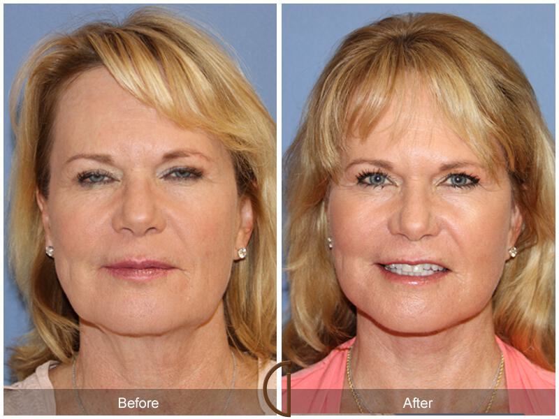 Facelift Sixties Before & After Photo