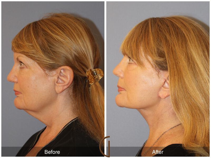 Facelift Sixties Before & After Photo