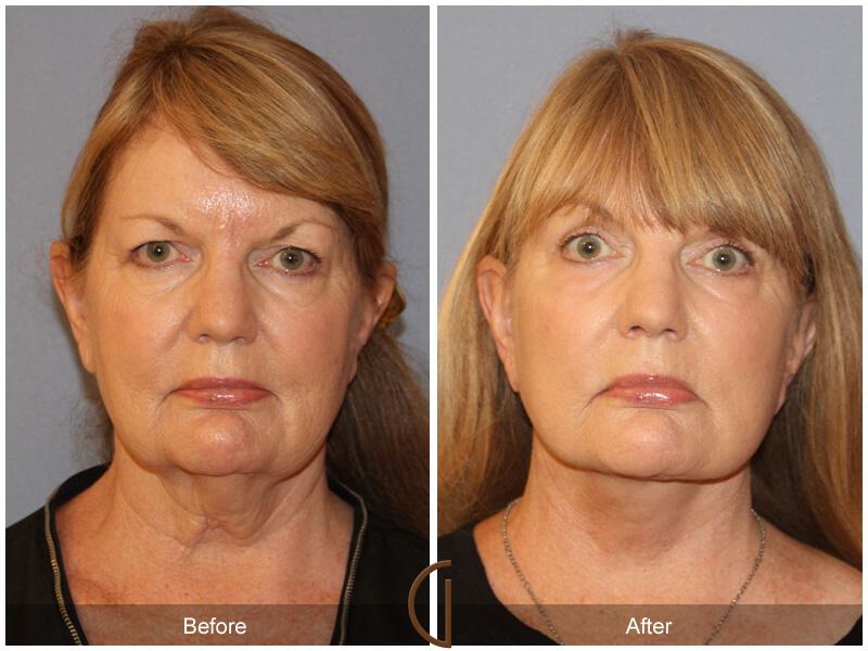 Facelift Sixties Before & After Photo