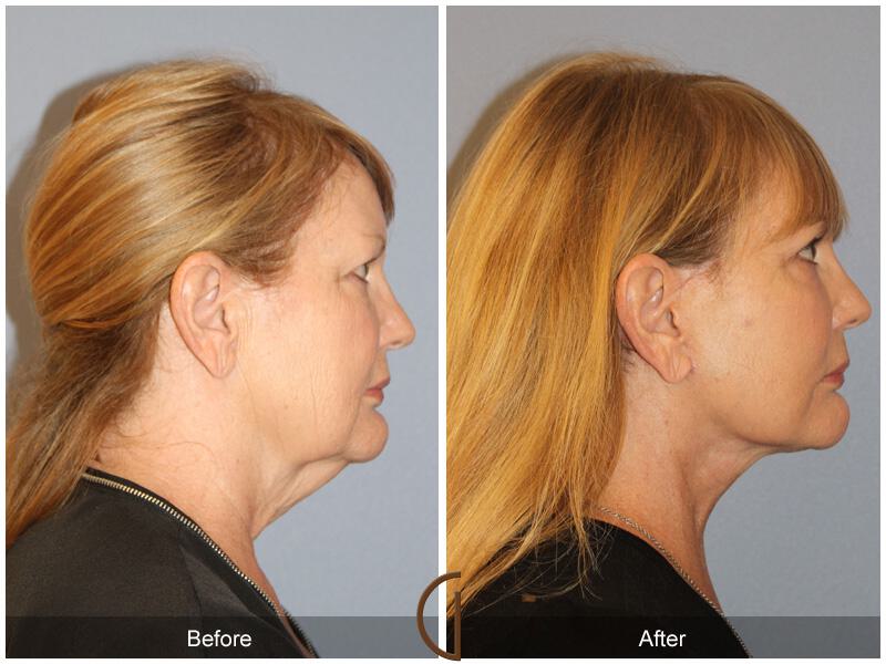 Facelift Sixties Before & After Photo