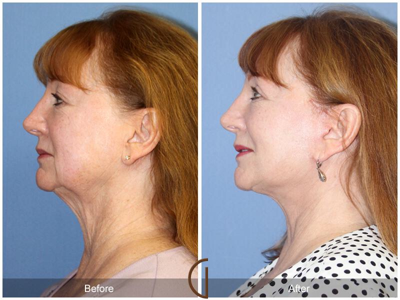 Facelift Sixties Before & After Photo