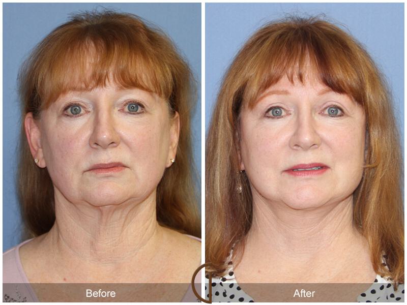 Facelift Sixties Before & After Photo