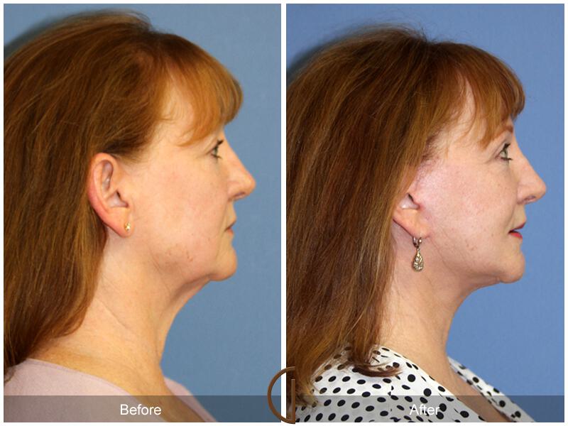 Facelift Sixties Before & After Photo